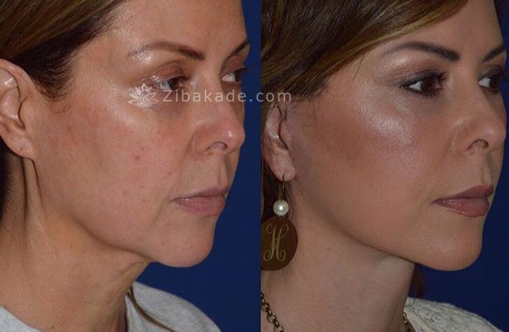 انواع روش های لیفت ابرو و روش انتخاب بهترین برای بیمار توسط دکتر امیر دریانی